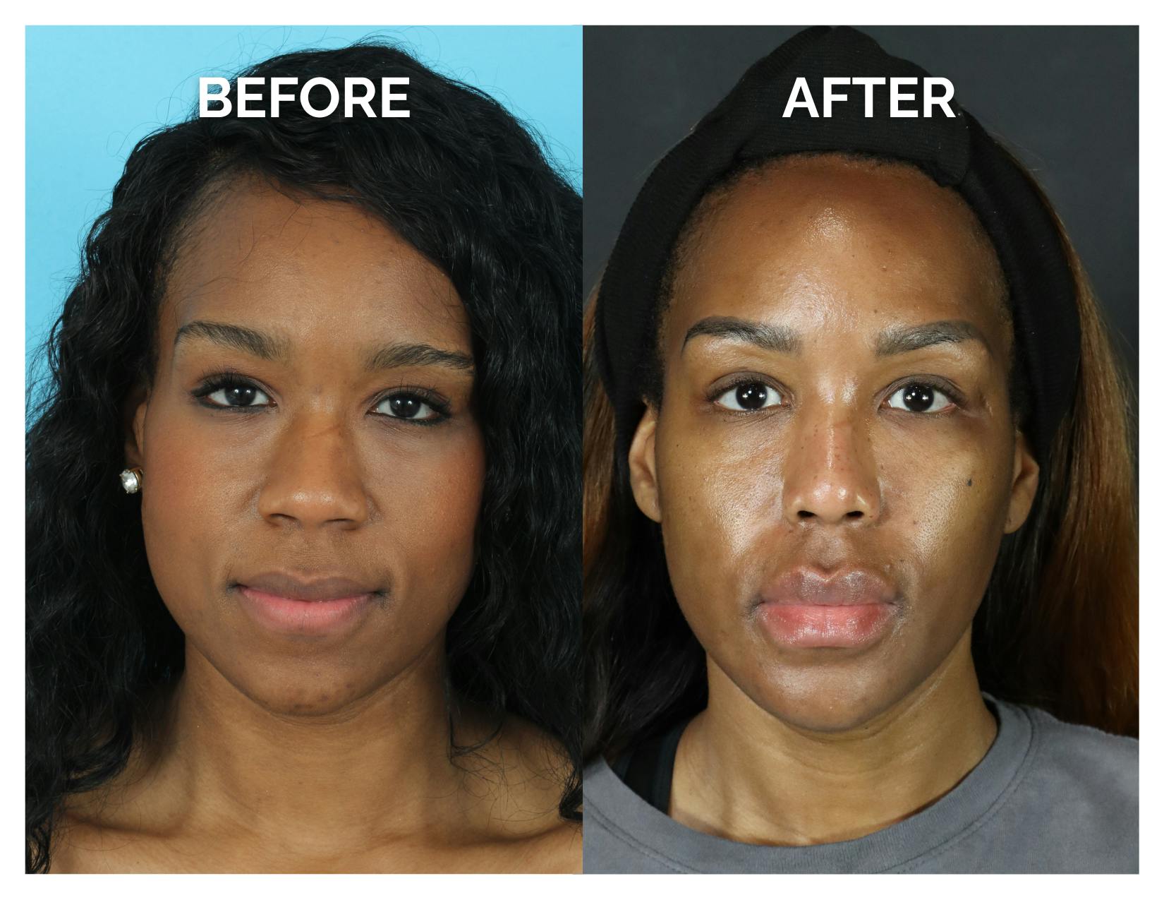 Rhinoplasty Before & After Gallery - Patient 213820 - Image 4
