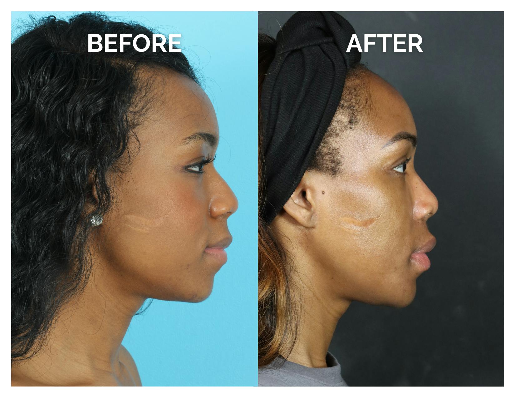 Rhinoplasty Before & After Gallery - Patient 213820 - Image 2