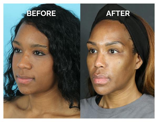 Rhinoplasty Before & After Gallery - Patient 213820 - Image 1