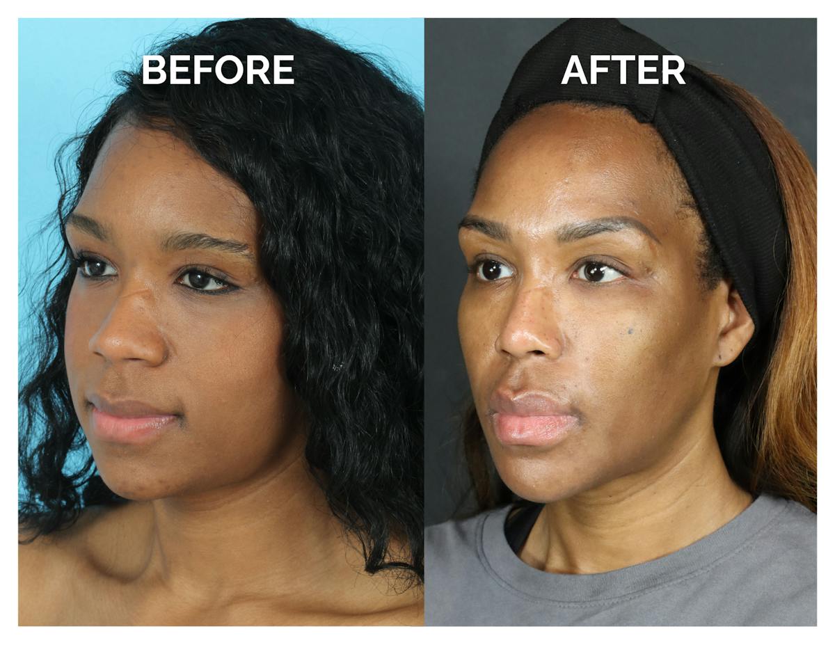 Rhinoplasty Before & After Gallery - Patient 213820 - Image 1