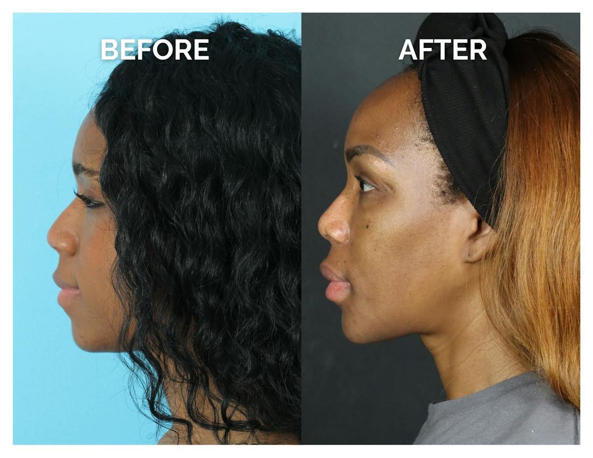 Rhinoplasty Before & After Gallery - Patient 213820 - Image 3