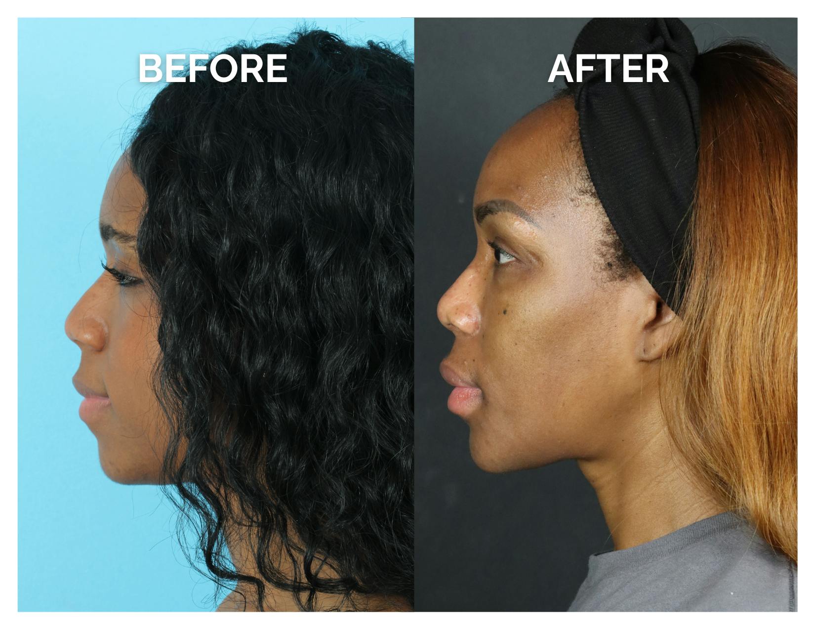 Rhinoplasty Before & After Gallery - Patient 213820 - Image 3