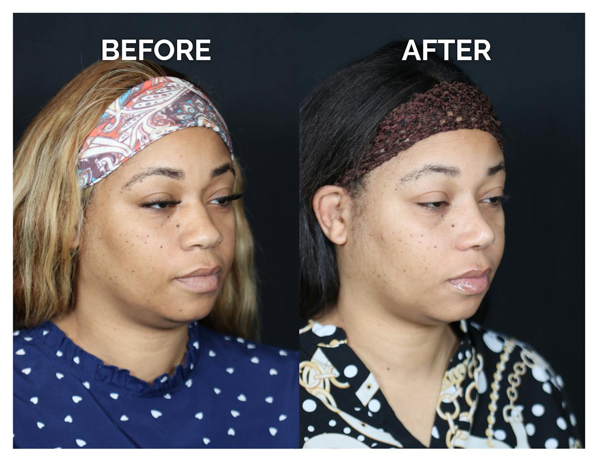 Rhinoplasty Before & After Gallery - Patient 381752 - Image 1