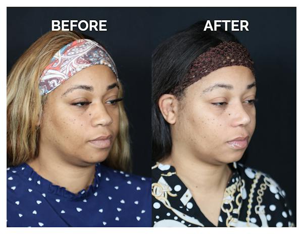 Rhinoplasty Before & After Gallery - Patient 381752 - Image 1