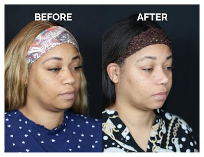 Rhinoplasty Before & After Gallery - Patient 381752 - Image 1