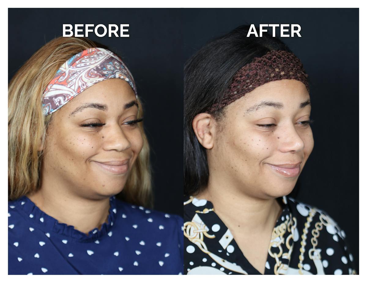 Rhinoplasty Before & After Gallery - Patient 381752 - Image 2