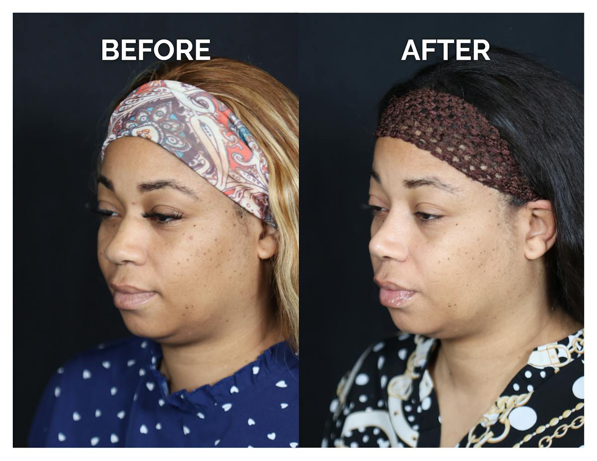 Rhinoplasty Before & After Gallery - Patient 381752 - Image 3
