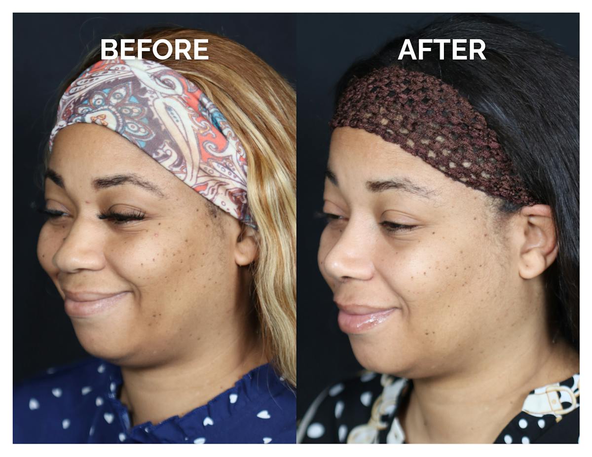 Rhinoplasty Before & After Gallery - Patient 381752 - Image 4