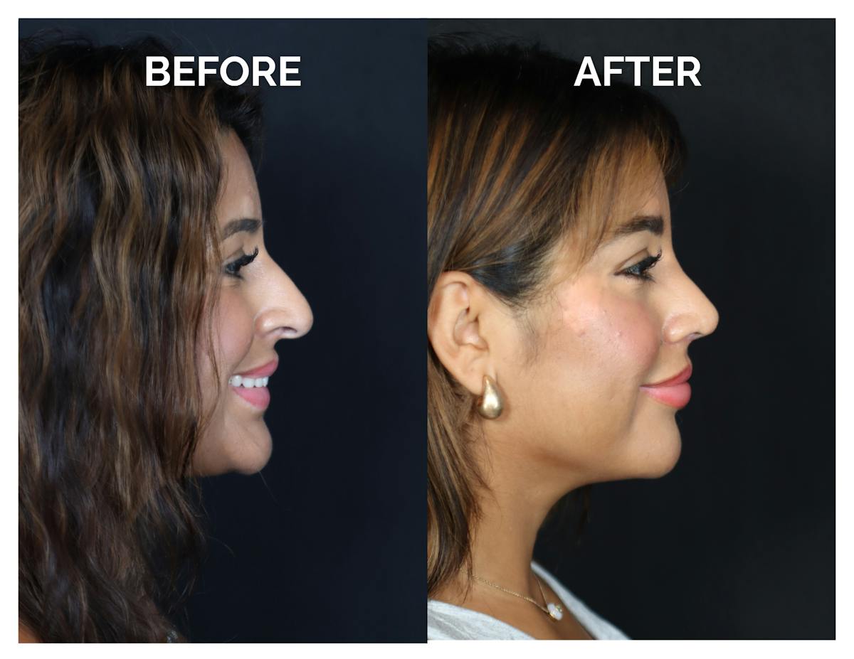 Rhinoplasty Before & After Gallery - Patient 212022 - Image 2