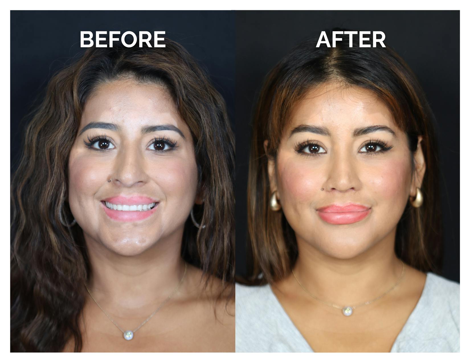 Rhinoplasty Before & After Gallery - Patient 212022 - Image 3