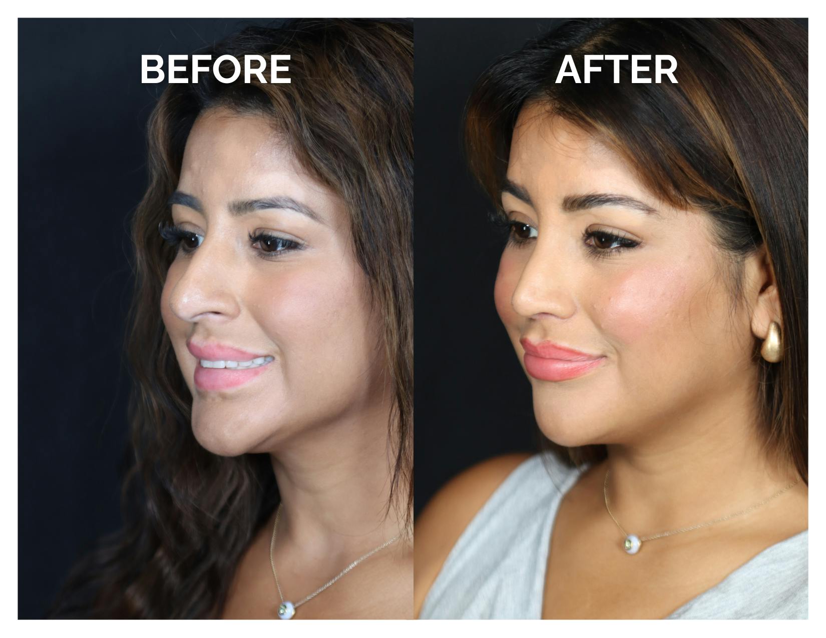 Rhinoplasty Before & After Gallery - Patient 212022 - Image 4