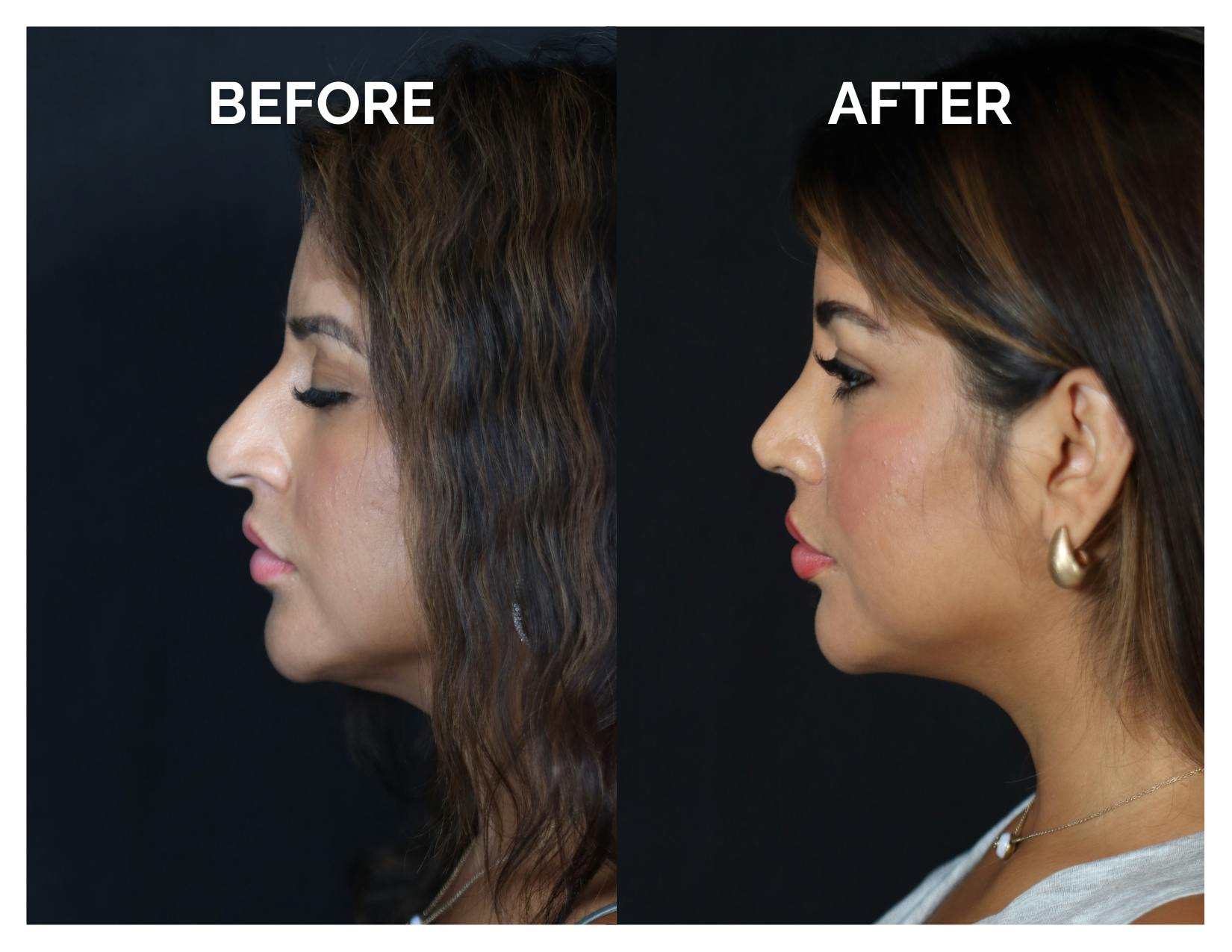 Rhinoplasty Before & After Gallery - Patient 212022 - Image 5