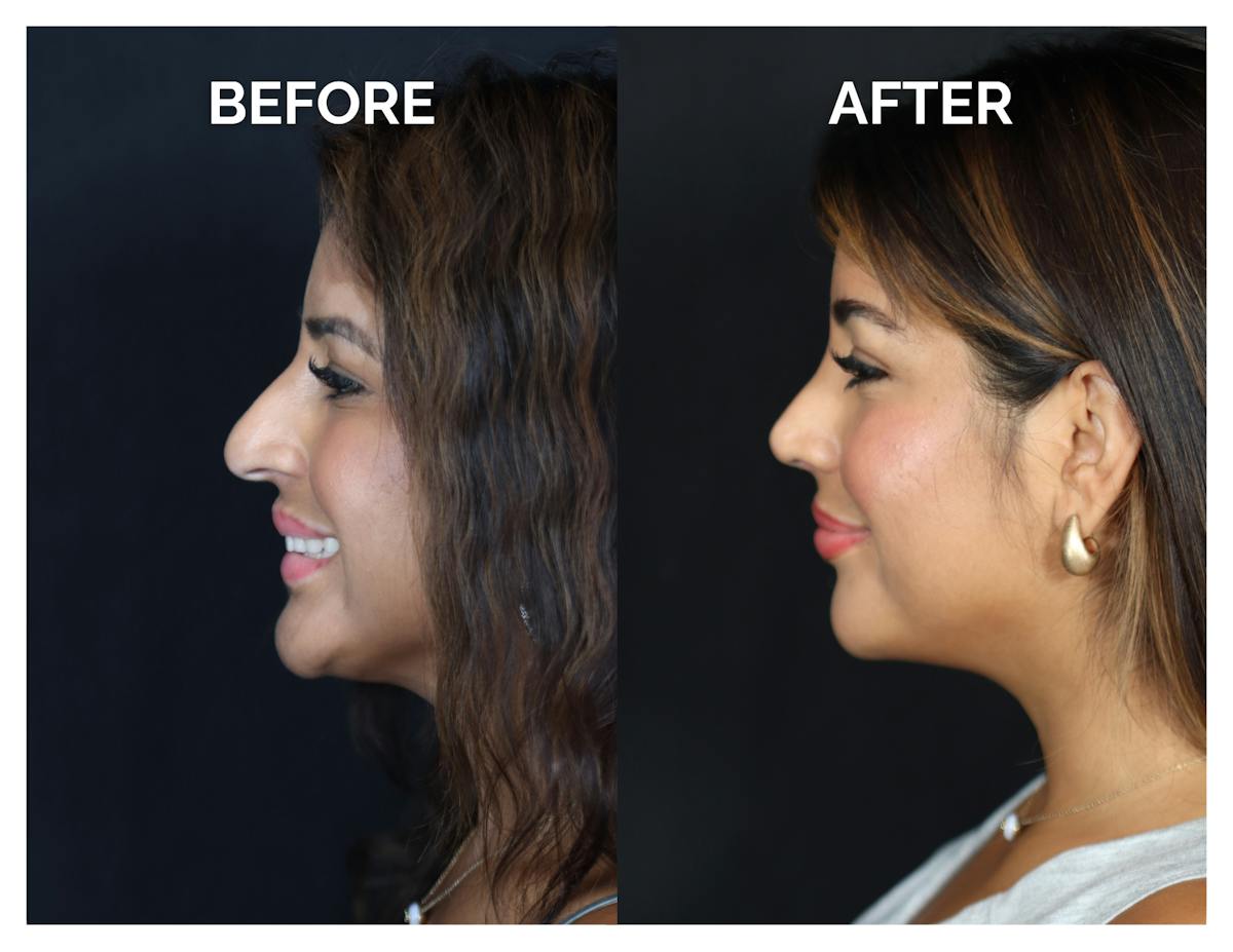 Rhinoplasty Before & After Gallery - Patient 212022 - Image 6