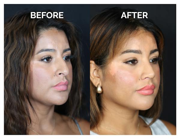 Rhinoplasty Before & After Gallery - Patient 212022 - Image 1