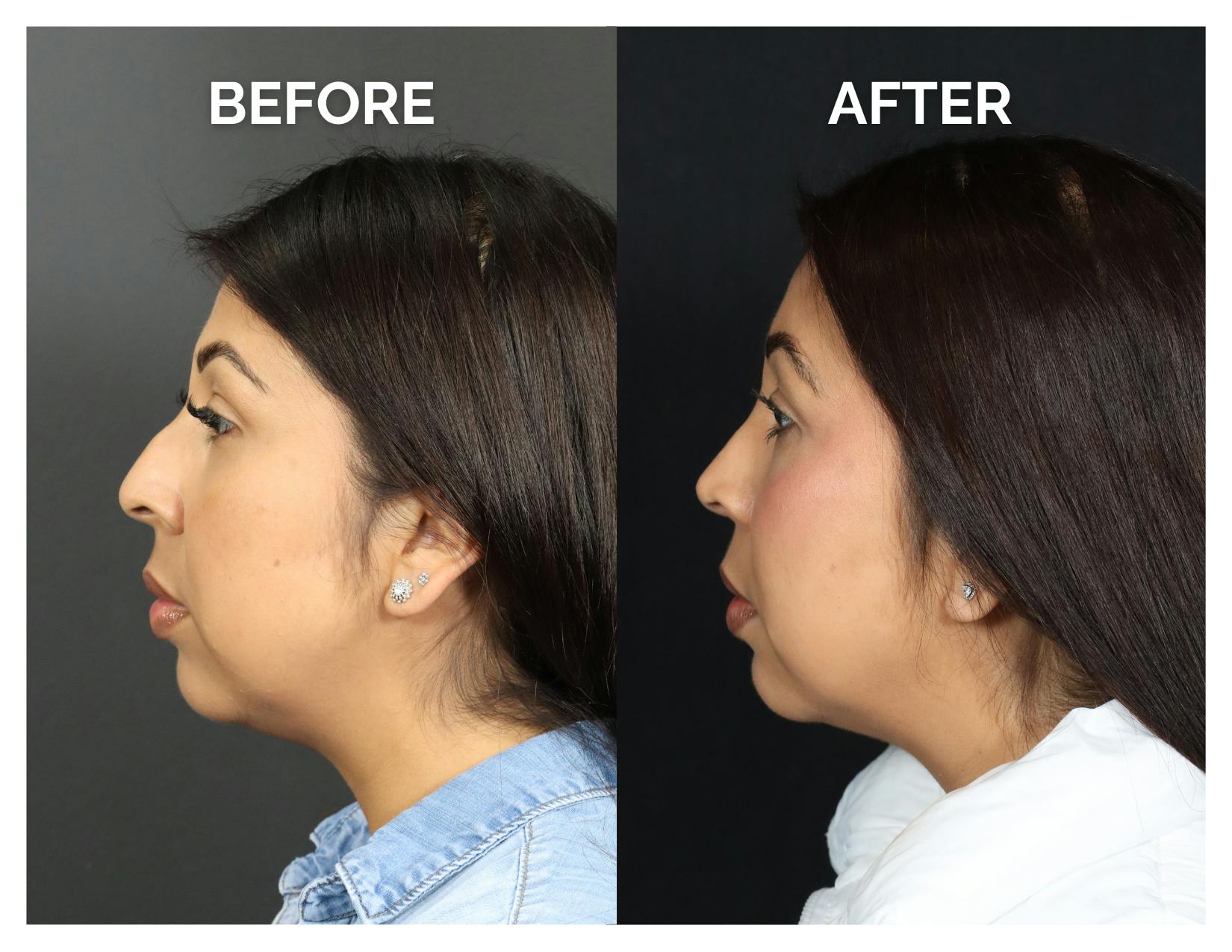 Rhinoplasty Before & After Gallery - Patient 277736 - Image 2