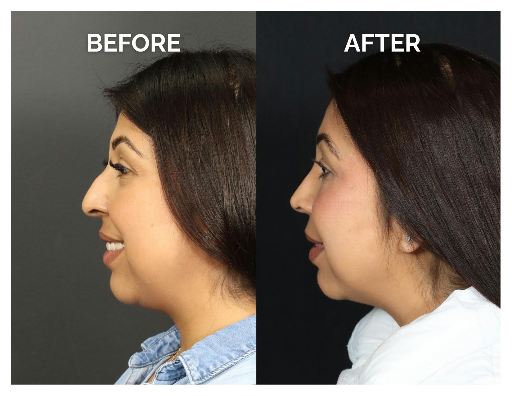 Rhinoplasty Before & After Gallery - Patient 277736 - Image 3