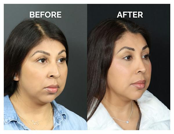 Rhinoplasty Before & After Gallery - Patient 277736 - Image 1