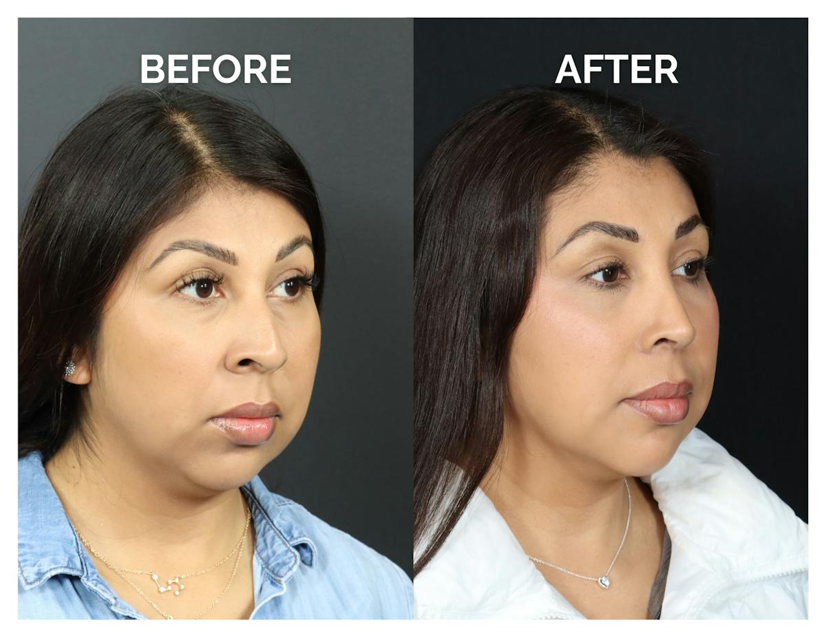 Rhinoplasty Before & After Gallery - Patient 277736 - Image 1