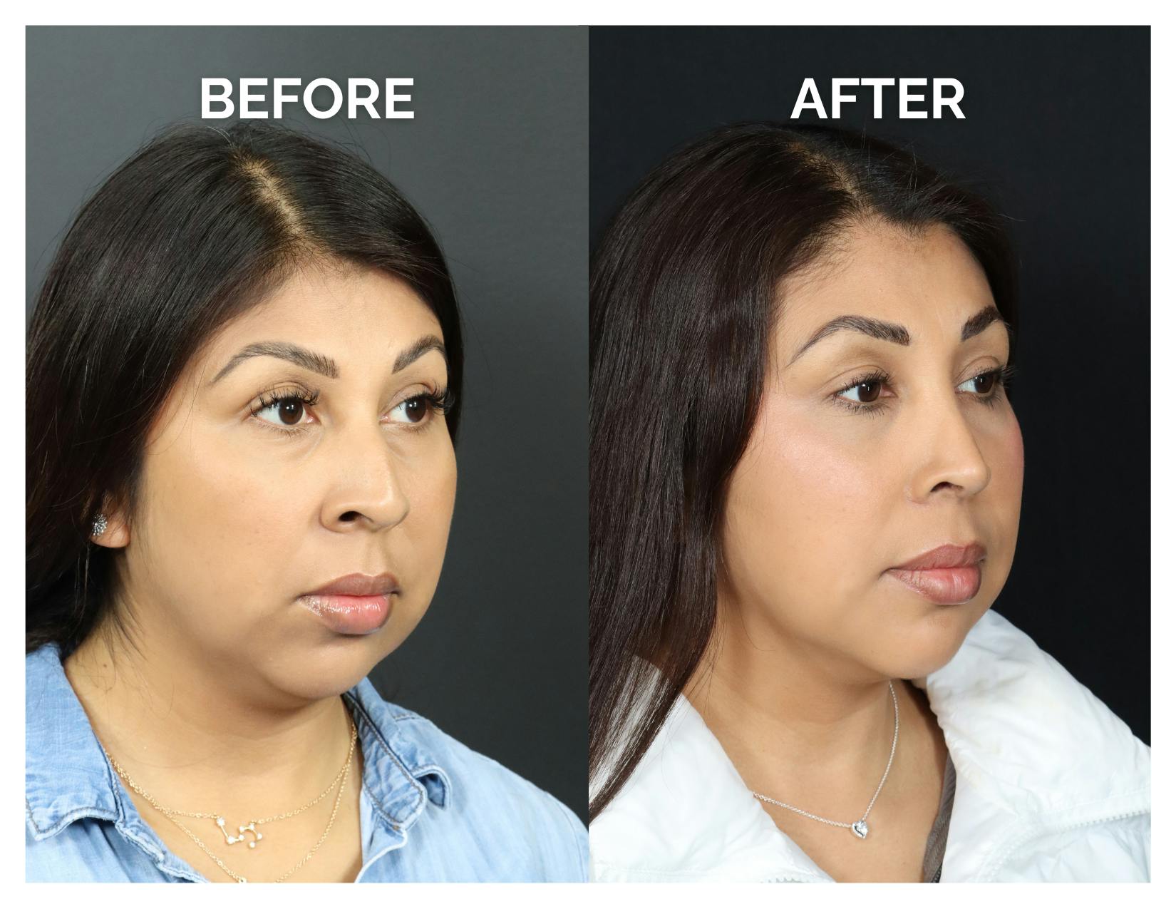 Rhinoplasty Before & After Gallery - Patient 277736 - Image 1