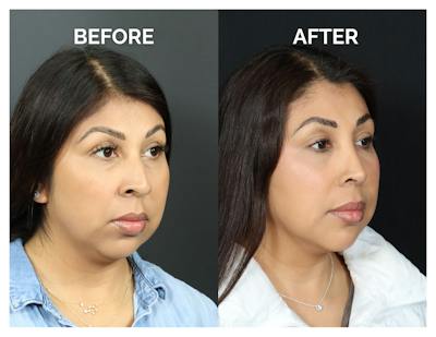 Rhinoplasty Before & After Gallery - Patient 277736 - Image 1