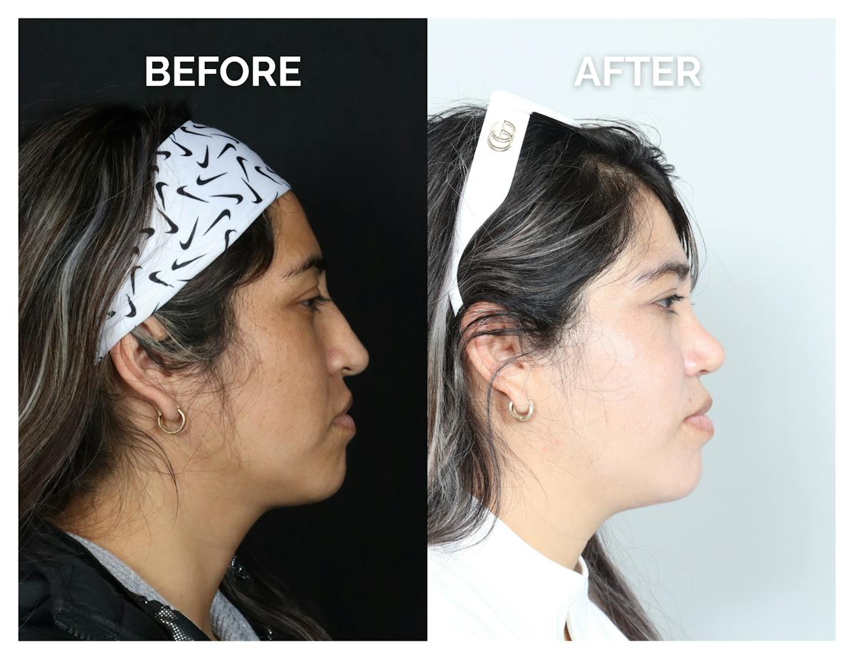 Rhinoplasty Before & After Gallery - Patient 135672 - Image 2