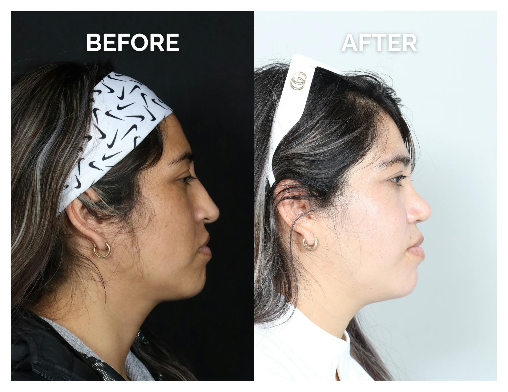 Rhinoplasty Before & After Gallery - Patient 135672 - Image 2
