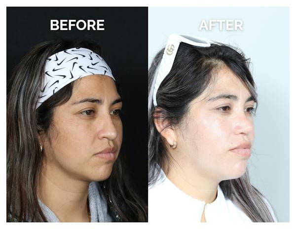 Rhinoplasty Before & After Gallery - Patient 135672 - Image 1