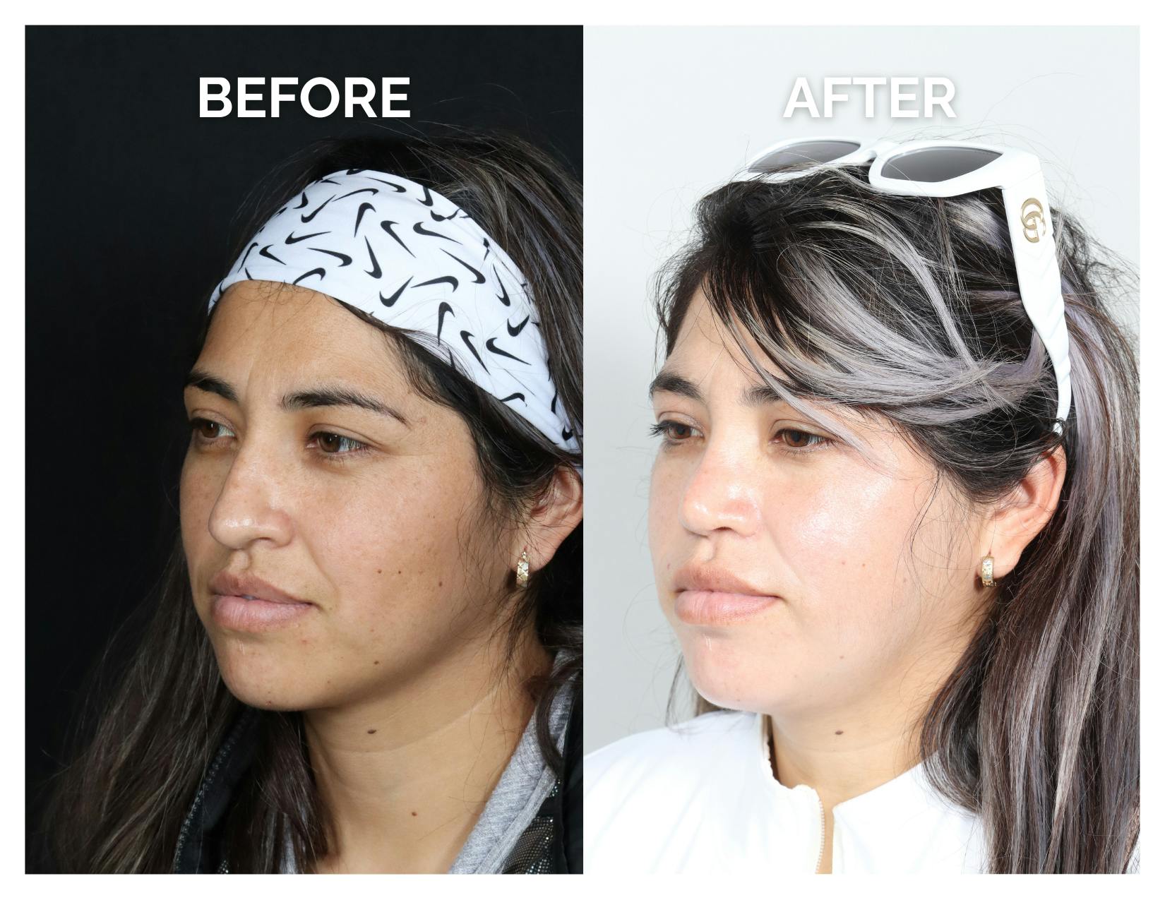Rhinoplasty Before & After Gallery - Patient 135672 - Image 3