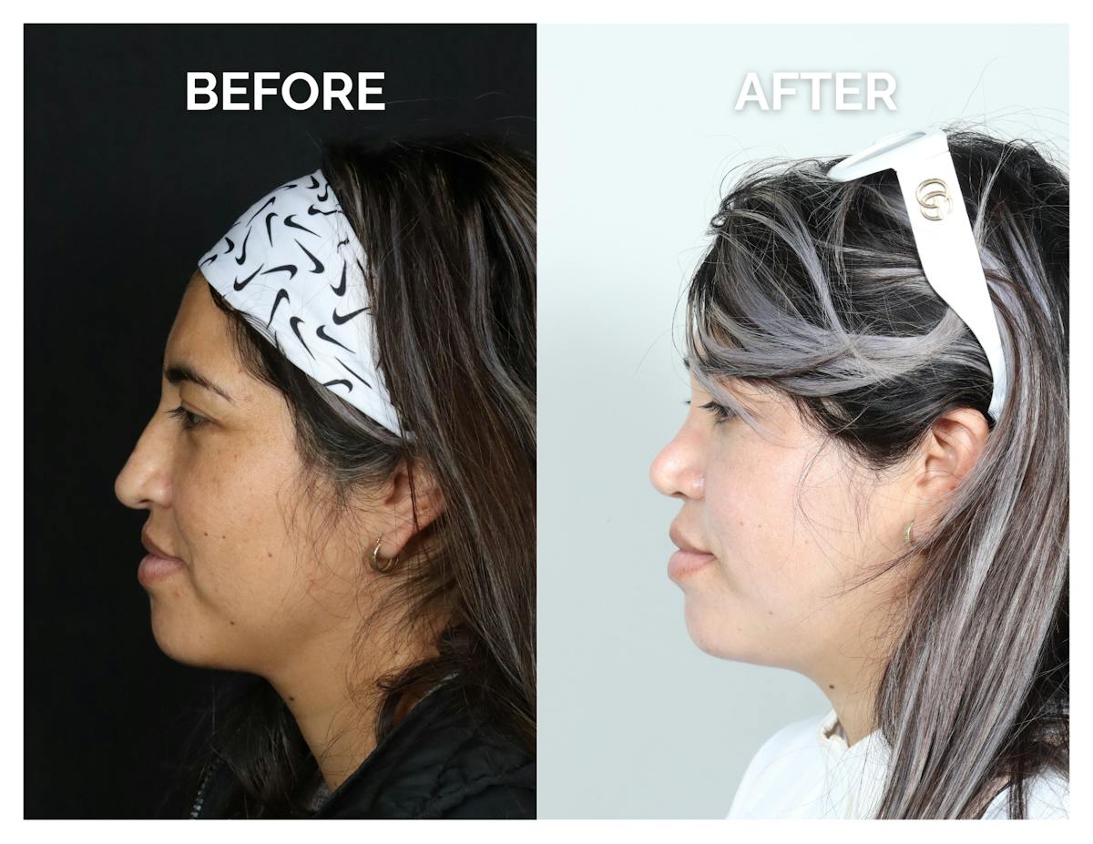 Rhinoplasty Before & After Gallery - Patient 135672 - Image 4