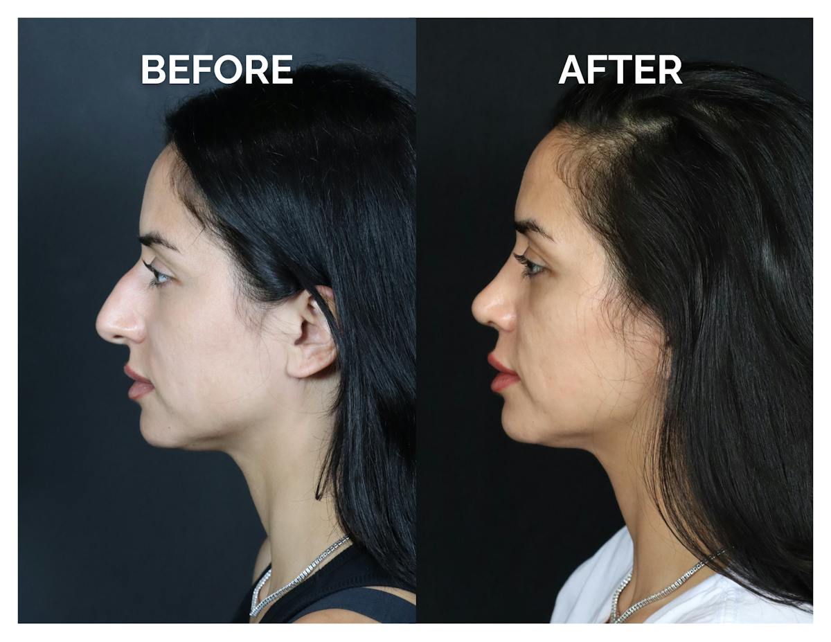 Rhinoplasty Before & After Gallery - Patient 215102 - Image 7