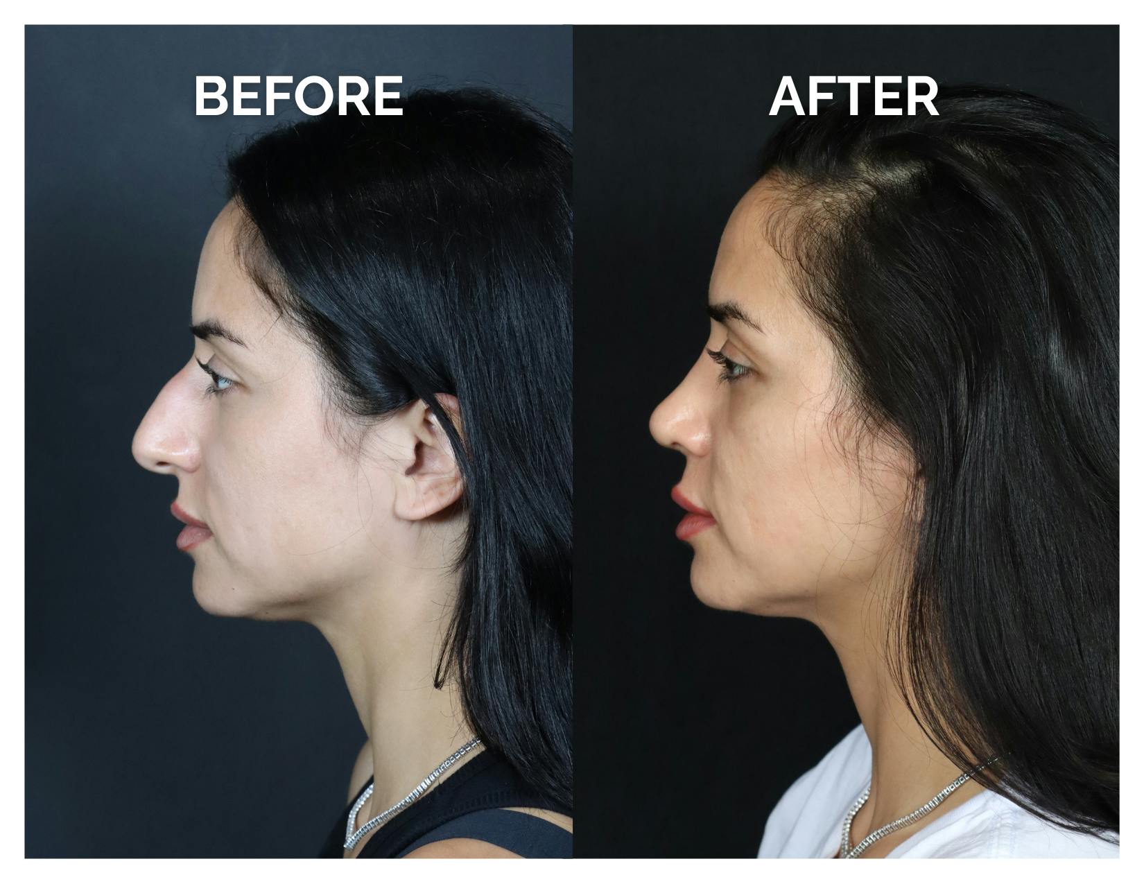 Rhinoplasty Before & After Gallery - Patient 215102 - Image 7