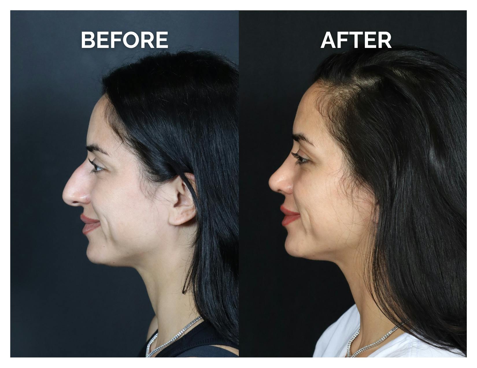 Rhinoplasty Before & After Gallery - Patient 215102 - Image 6