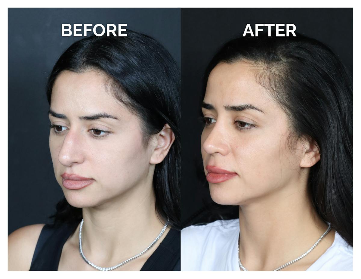 Rhinoplasty Before & After Gallery - Patient 215102 - Image 5