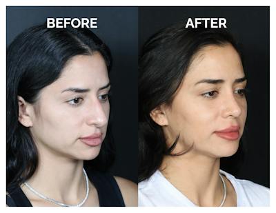 Rhinoplasty Before & After Gallery - Patient 215102 - Image 1