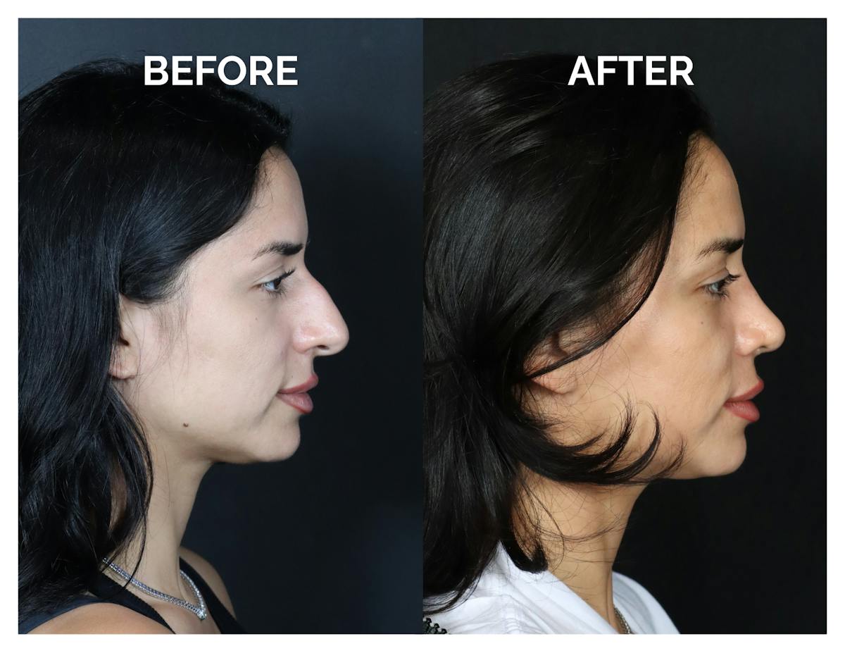 Rhinoplasty Before & After Gallery - Patient 215102 - Image 2