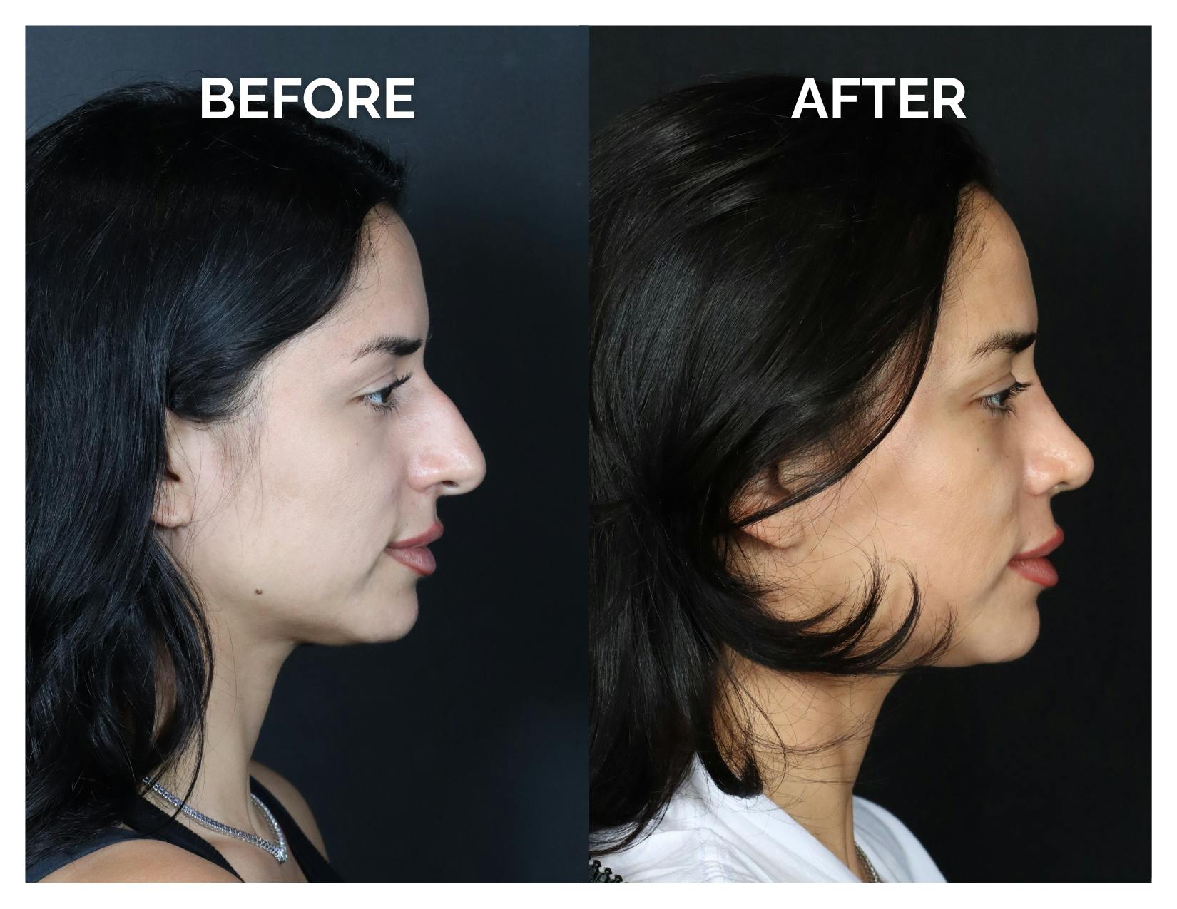 Rhinoplasty Before & After Gallery - Patient 215102 - Image 2