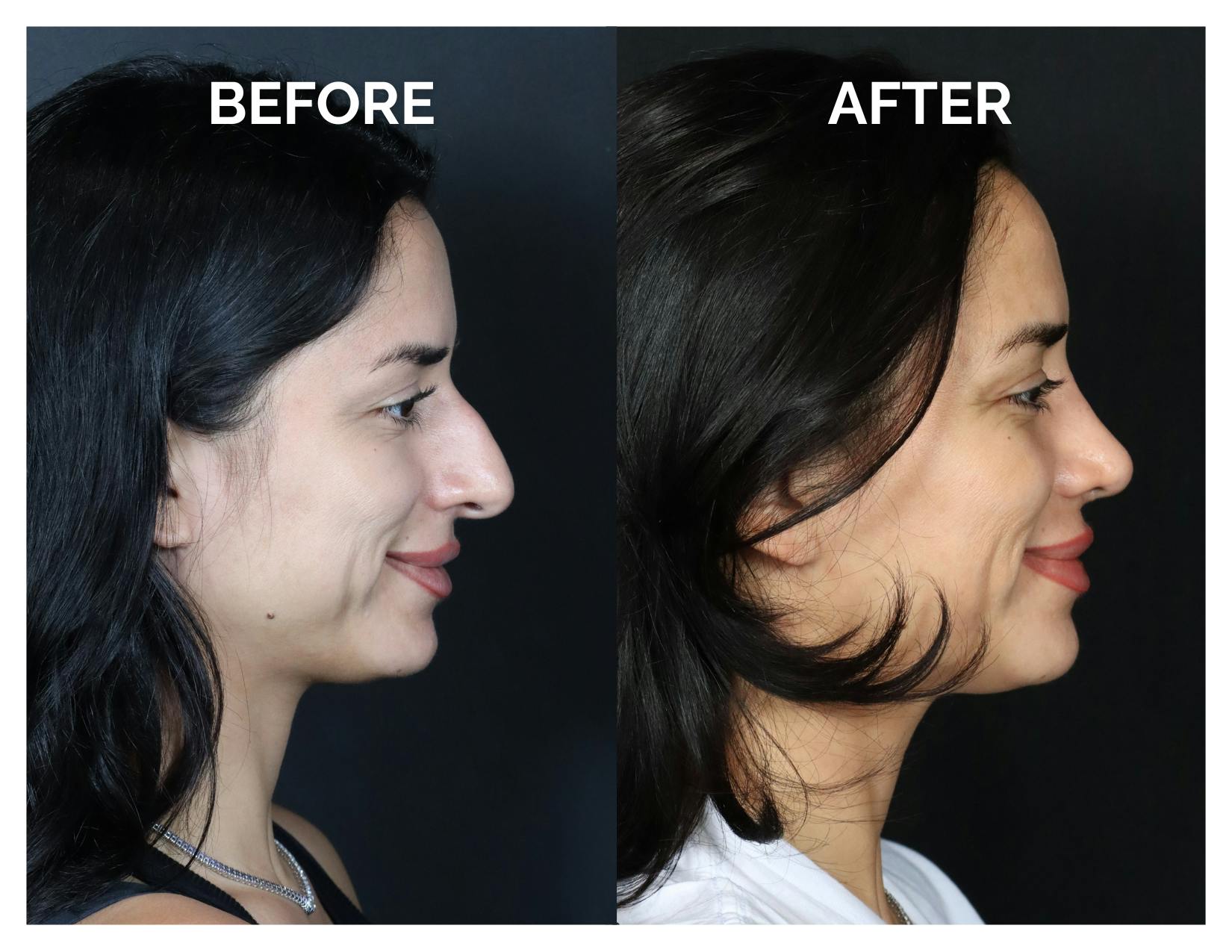 Rhinoplasty Before & After Gallery - Patient 215102 - Image 3