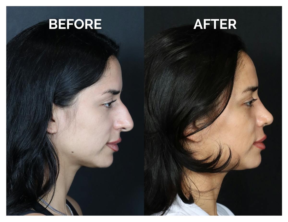 Rhinoplasty Before & After Gallery - Patient 215102 - Image 4