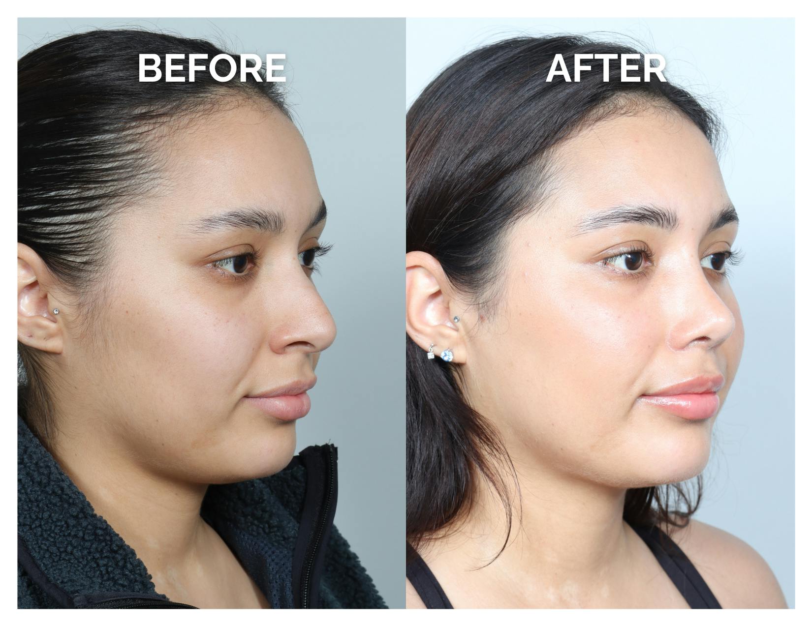 Rhinoplasty Before & After Gallery - Patient 368077 - Image 1