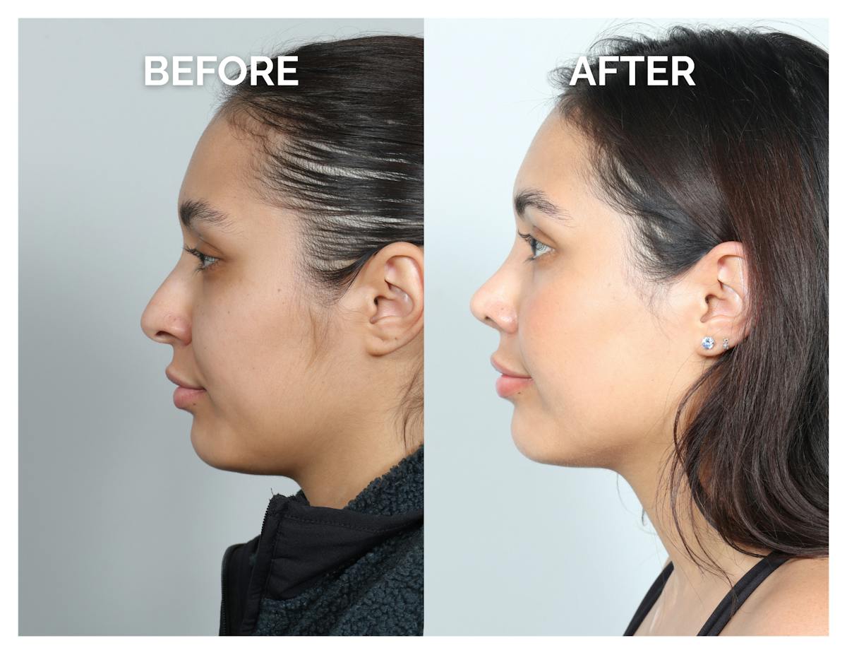 Rhinoplasty Before & After Gallery - Patient 368077 - Image 4
