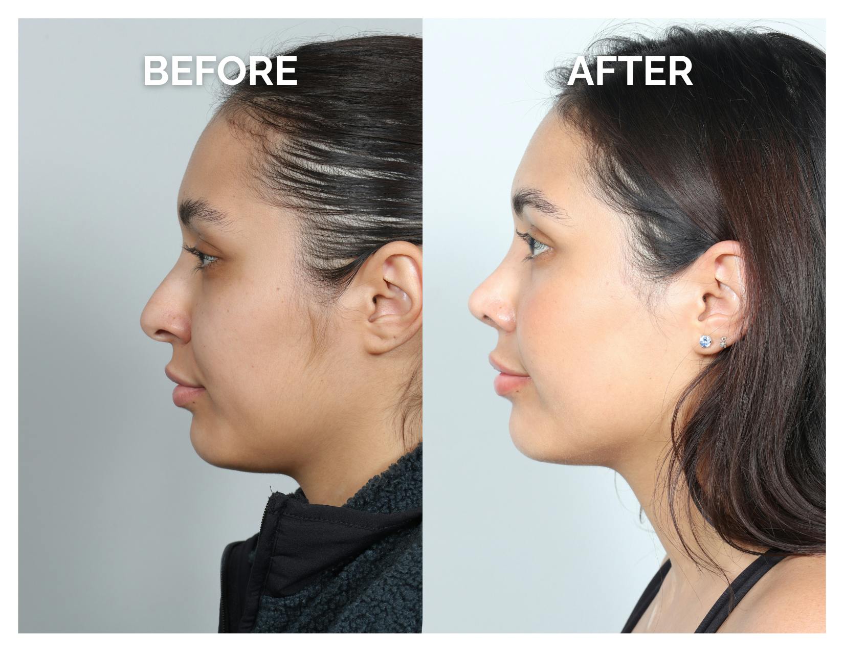 Rhinoplasty Before & After Gallery - Patient 368077 - Image 4