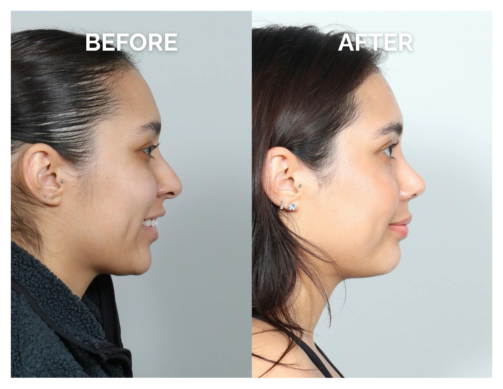 Rhinoplasty Before & After Gallery - Patient 368077 - Image 2