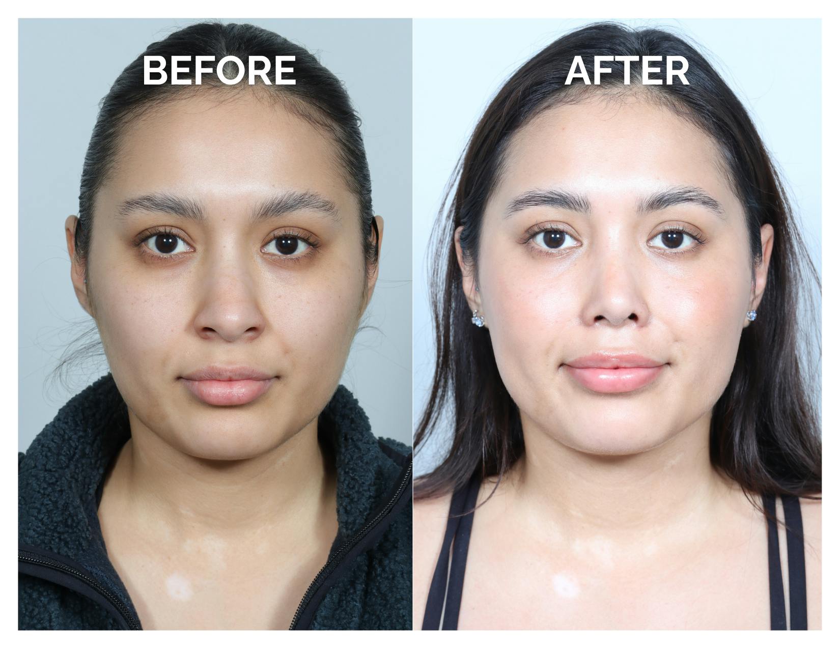 Rhinoplasty Before & After Gallery - Patient 368077 - Image 3