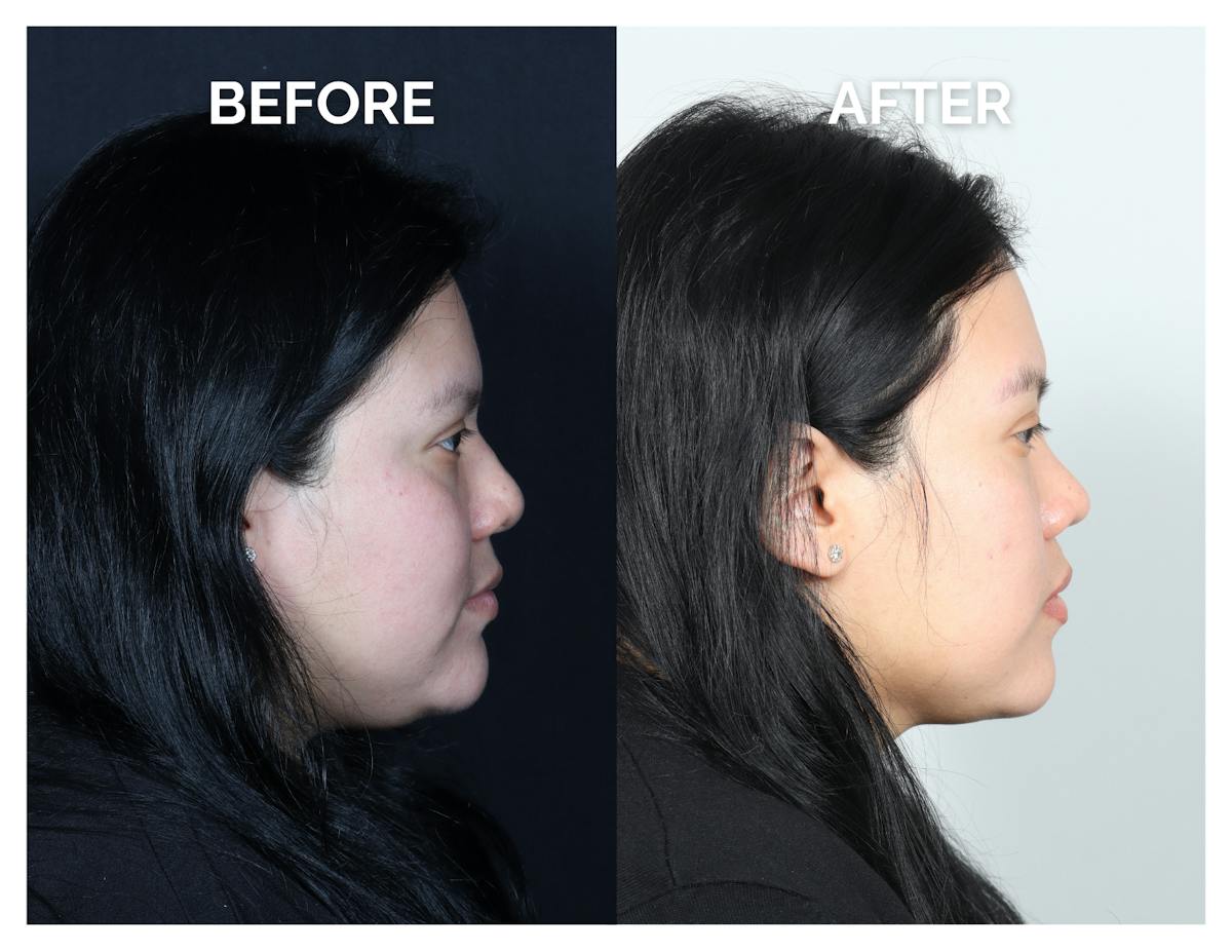 Rhinoplasty Before & After Gallery - Patient 153300 - Image 2