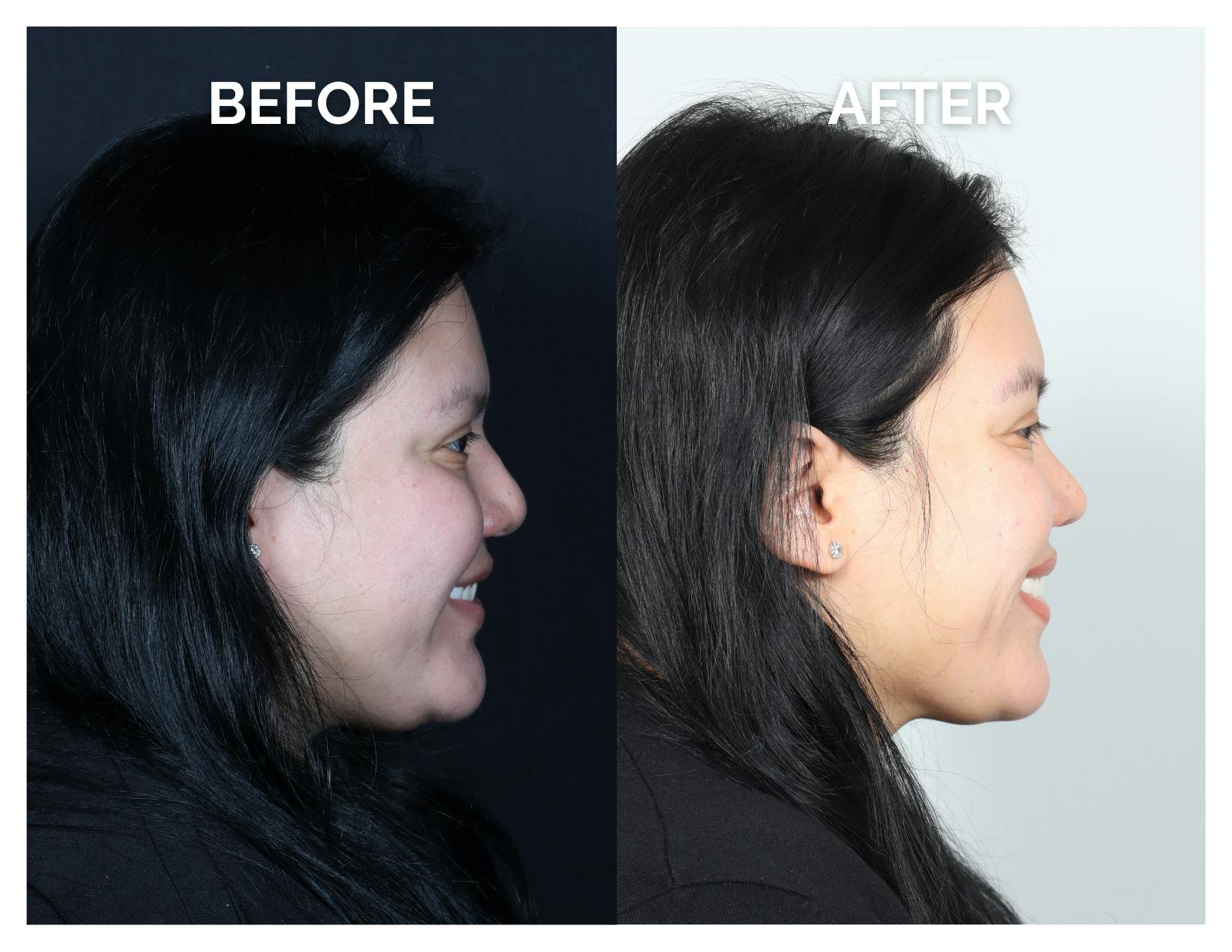Rhinoplasty Before & After Gallery - Patient 153300 - Image 3