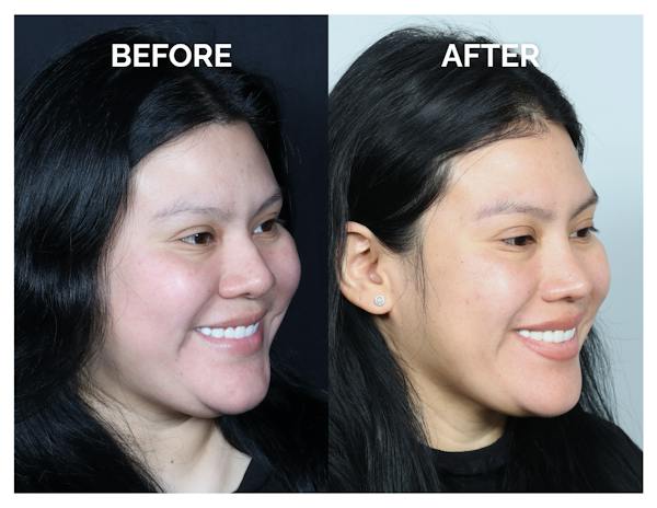 Rhinoplasty Before & After Gallery - Patient 153300 - Image 1