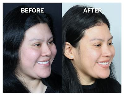 Rhinoplasty Before & After Gallery - Patient 153300 - Image 1