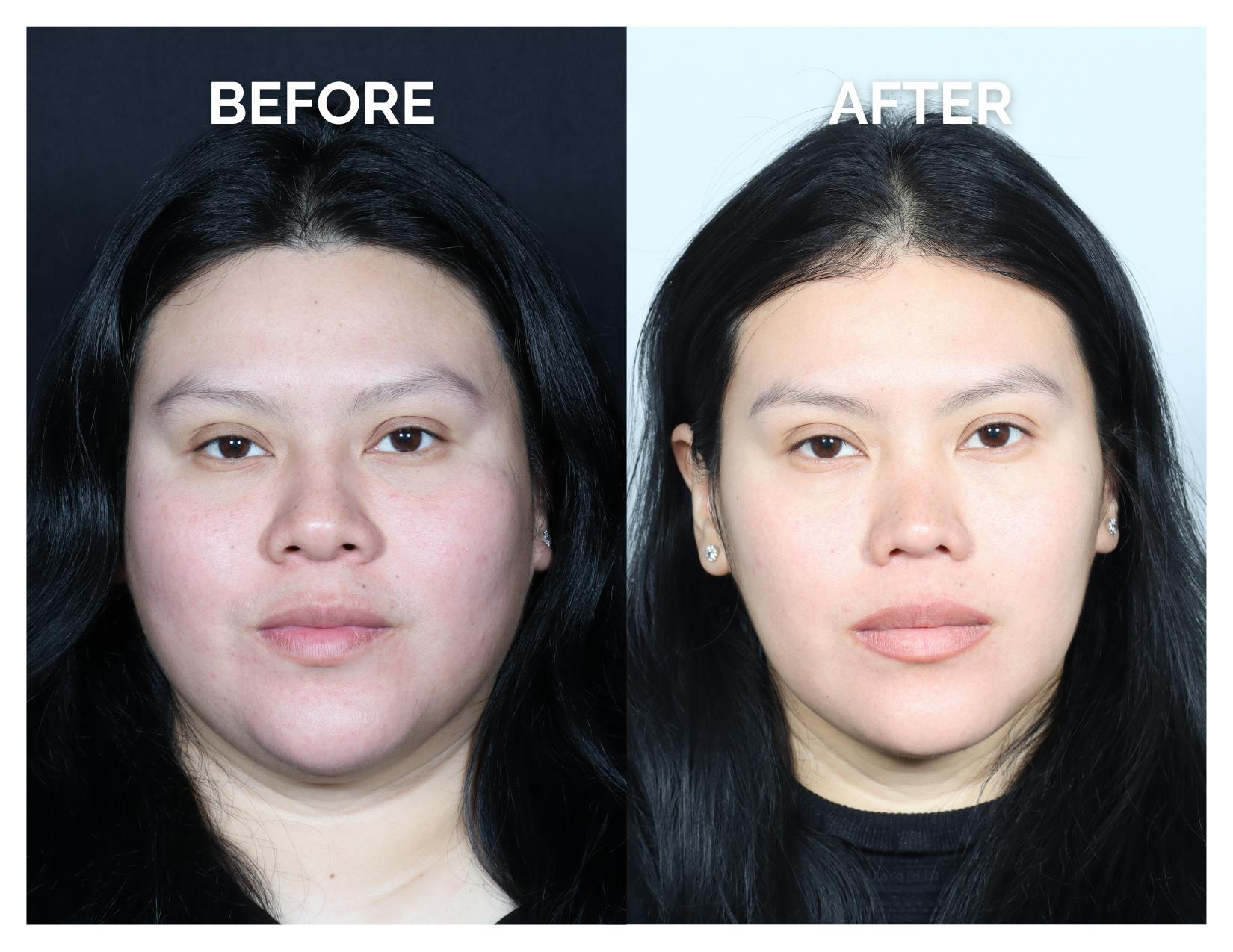 Rhinoplasty Before & After Gallery - Patient 153300 - Image 5