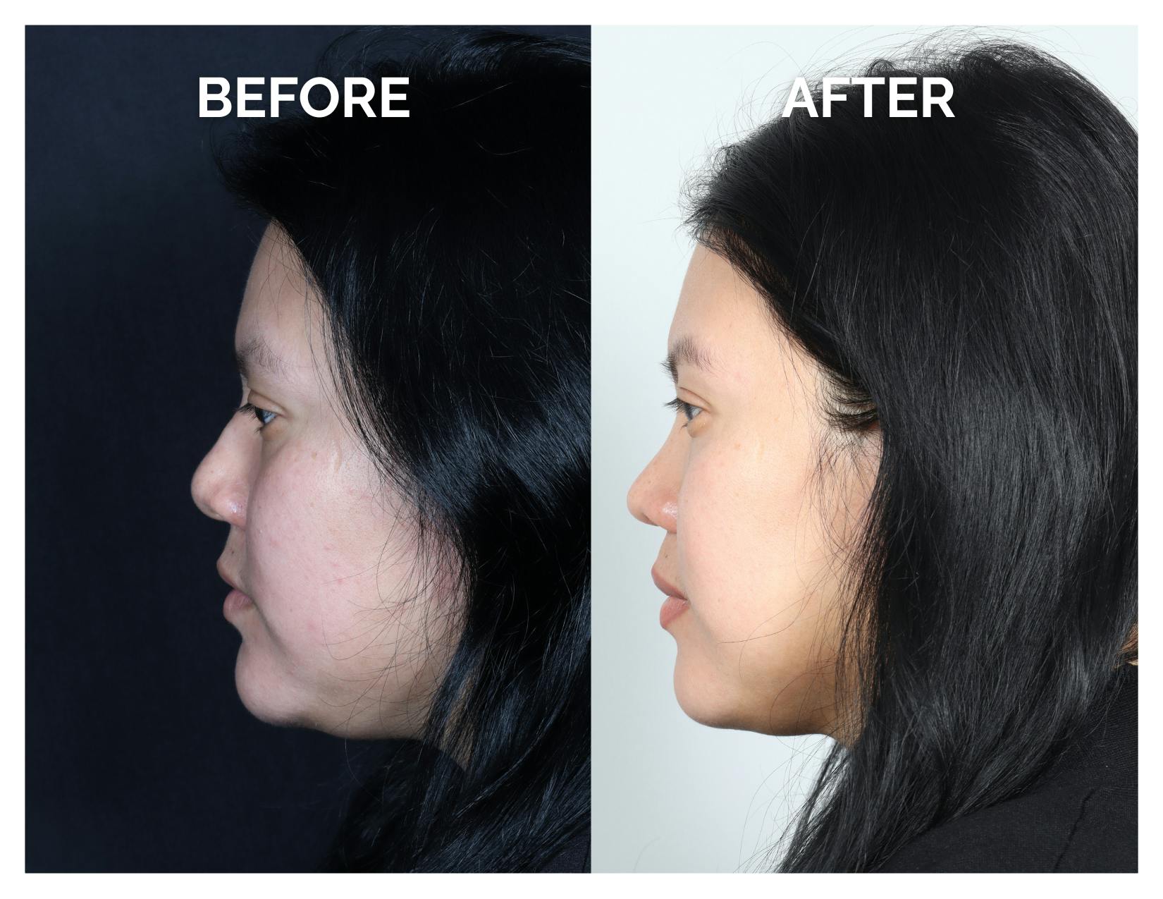 Rhinoplasty Before & After Gallery - Patient 153300 - Image 4