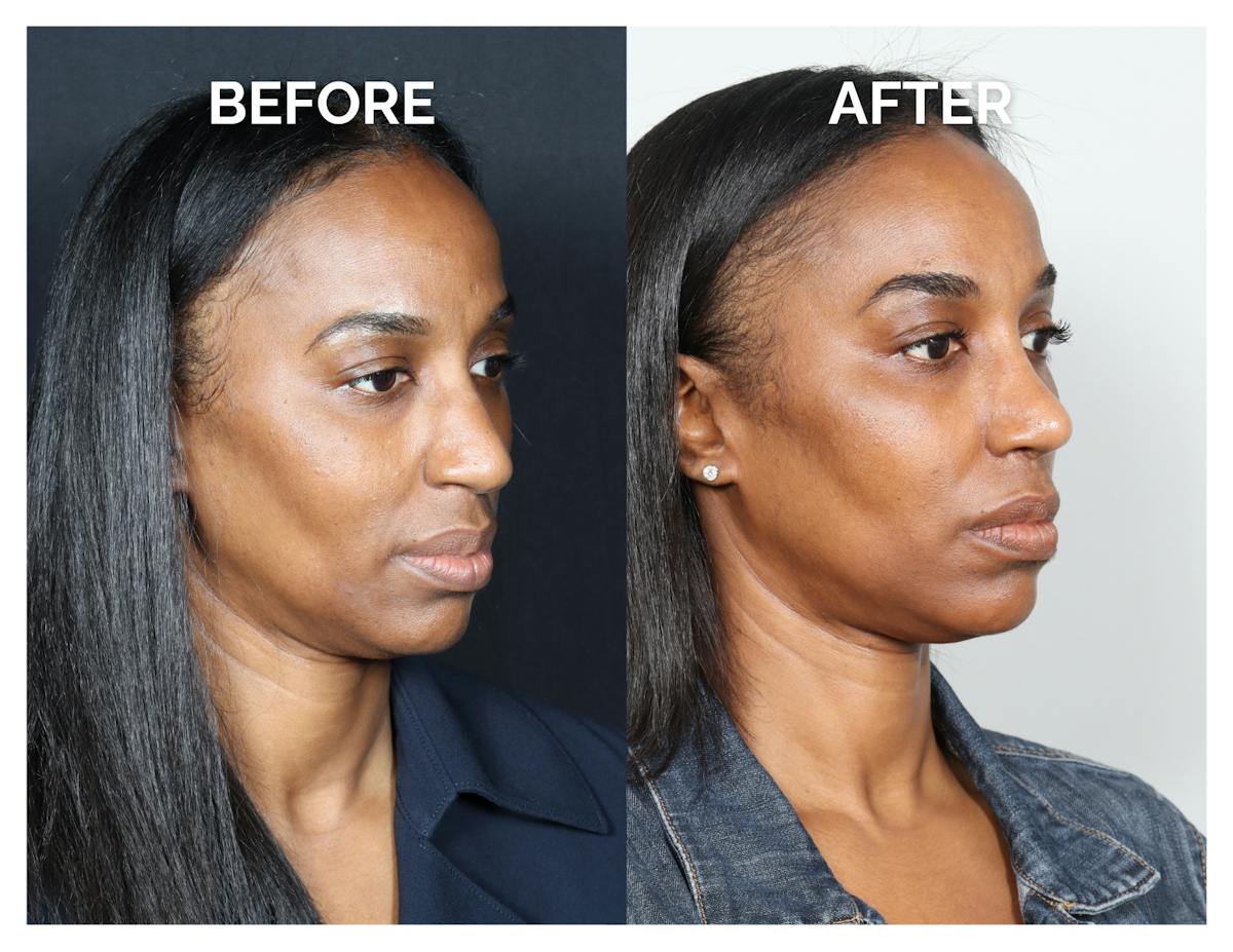 Rhinoplasty Before & After Gallery - Patient 305473 - Image 1